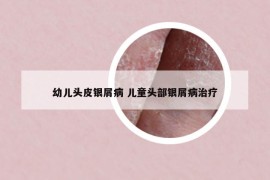 幼兒頭皮銀屑病 兒童頭部銀屑病治療