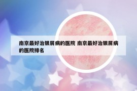 南京最好治銀屑病的醫(yī)院 南京最好治銀屑病的醫(yī)院排名