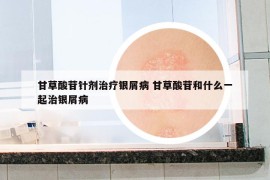 甘草酸苷針劑治療銀屑病 甘草酸苷和什么一起治銀屑病