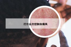 打什么針控制白癜風(fēng)