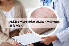 腰上起了一塊干燥像癬 腰上起了一塊干燥像癬 越來越大