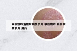 甲氨蝶呤治銀屑病關(guān)節(jié)炎 甲氨蝶呤 銀屑病關(guān)節(jié)炎 用藥
