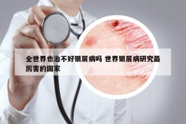 全世界也治不好銀屑病嗎 世界銀屑病研究最厲害的國家