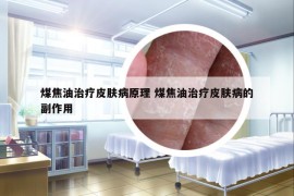 煤焦油治療皮膚病原理 煤焦油治療皮膚病的副作用