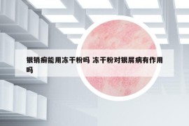 銀銷癬能用凍干粉嗎 凍干粉對(duì)銀屑病有作用嗎