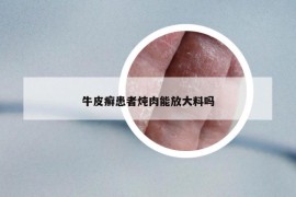 牛皮癬患者燉肉能放大料嗎