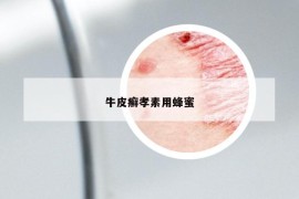 牛皮癬孝素用蜂蜜