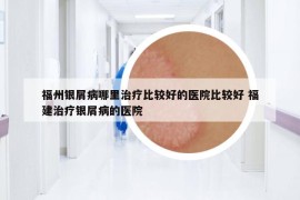 福州銀屑病哪里治療比較好的醫(yī)院比較好 福建治療銀屑病的醫(yī)院