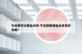 牛皮癬可以敷鹽水嗎 牛皮膚癬用鹽水洗有好處嘛?