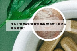 什么土方法可以治療牛皮癬 有沒有土辦法治牛皮廨治療
