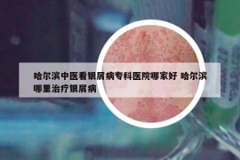 哈爾濱中醫(yī)看銀屑病專科醫(yī)院哪家好 哈爾濱哪里治療銀屑病