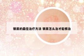銀屑的最佳治療方法 銀屑怎么治才能根治