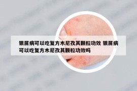 銀屑病可以吃復方木尼孜其顆粒功效 銀屑病可以吃復方木尼孜其顆粒功效嗎
