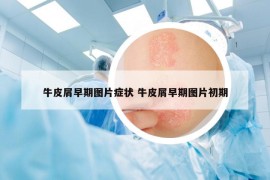 牛皮屑早期圖片癥狀 牛皮屑早期圖片初期