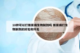 18種可以打銀屑病生物制劑嗎 銀屑病打生物制劑的好處和壞處