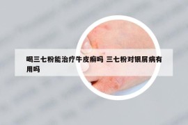 喝三七粉能治療牛皮癬嗎 三七粉對(duì)銀屑病有用嗎