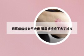 銀屑病痘痘會(huì)不會(huì)癢 銀屑病痘痘下去了掉皮