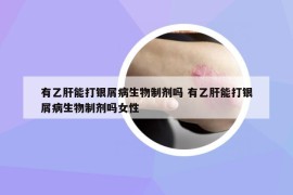 有乙肝能打銀屑病生物制劑嗎 有乙肝能打銀屑病生物制劑嗎女性