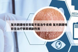 復(fù)方酮康唑軟膏能不能治牛皮癬 復(fù)方酮康唑軟膏治療銀屑病副作用