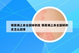 銀屑病上身全部掉剝皮 銀屑病上身全部掉剝皮怎么回事