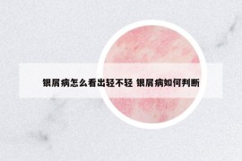 銀屑病怎么看出輕不輕 銀屑病如何判斷