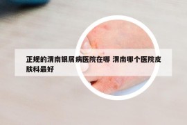 正規(guī)的渭南銀屑病醫(yī)院在哪 渭南哪個醫(yī)院皮膚科最好