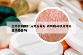 患銀屑病用什么沐浴露好 銀屑病可以用沐浴露洗身體嗎