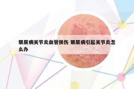 銀屑病關(guān)節(jié)炎血管損傷 銀屑病引起關(guān)節(jié)炎怎么辦