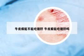 牛皮癬能不能吃豬肝 牛皮廨能吃豬肝嗎
