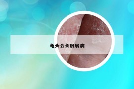 龜頭會長銀屑病