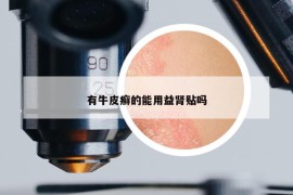 有牛皮癬的能用益腎貼嗎