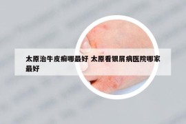 太原治牛皮癬哪最好 太原看銀屑病醫(yī)院哪家最好