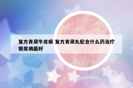 復方青黛牛皮癬 復方青黛丸配合什么藥治療銀屑病最好