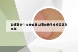 益賽普治牛皮癬效果 益賽普治牛皮癬效果怎么樣