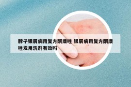 脖子銀屑病用復(fù)方酮康唑 銀屑病用復(fù)方酮康唑發(fā)用洗劑有效嗎