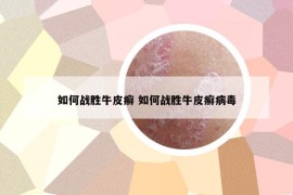 如何戰(zhàn)勝牛皮癬 如何戰(zhàn)勝牛皮癬病毒