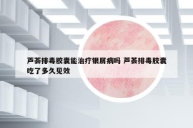 蘆薈排毒膠囊能治療銀屑病嗎 蘆薈排毒膠囊吃了多久見效