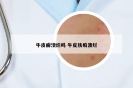 牛皮癬潰爛嗎 牛皮膚癬潰爛