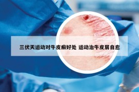 三伏天運(yùn)動(dòng)對(duì)牛皮癬好處 運(yùn)動(dòng)治牛皮屑自愈