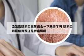 泛發(fā)性膿皰型銀屑病會(huì)一下就得了嗎 膿皰型銀屑病復(fù)發(fā)還是膿皰型嗎