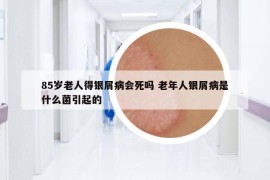85歲老人得銀屑病會(huì)死嗎 老年人銀屑病是什么菌引起的