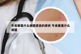 牛皮癬是什么細菌感染的癥狀 牛皮廨是什么細菌