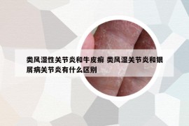 類風(fēng)濕性關(guān)節(jié)炎和牛皮癬 類風(fēng)濕關(guān)節(jié)炎和銀屑病關(guān)節(jié)炎有什么區(qū)別