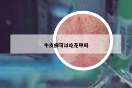 牛皮癬可以吃花甲嗎