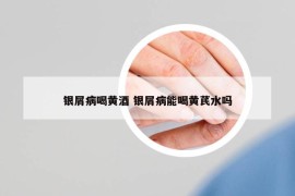 銀屑病喝黃酒 銀屑病能喝黃芪水嗎