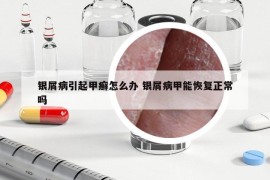 銀屑病引起甲癬怎么辦 銀屑病甲能恢復(fù)正常嗎