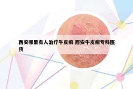 西安哪里有人治療牛皮癬 西安牛皮癬?？漆t(yī)院