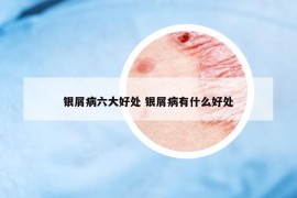 銀屑病六大好處 銀屑病有什么好處