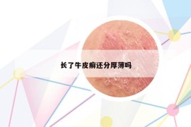 長了牛皮癬還分厚薄嗎