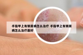 手指甲上有銀屑病怎么治療 手指甲上有銀屑病怎么治療最好